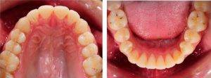 Active Aligners Before and After