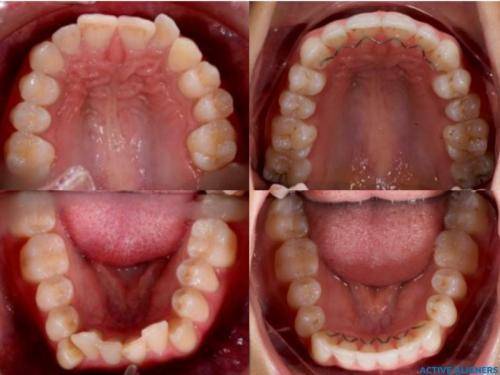 Active Aligner results