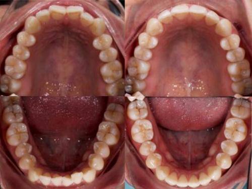 Active-Aligners-before-and-after-reviews