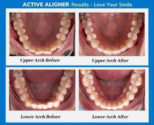 Active Aligners review before and after