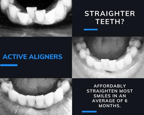 ActiveAligners before and after lower arch